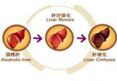酒精肝演變過程