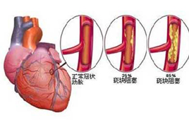 為什么冠心病在冬季高發(fā)?預(yù)防冠心病的方法補硒